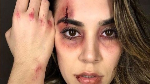 Naiara Azevedo é criticada após publicar foto machucada em post sobre