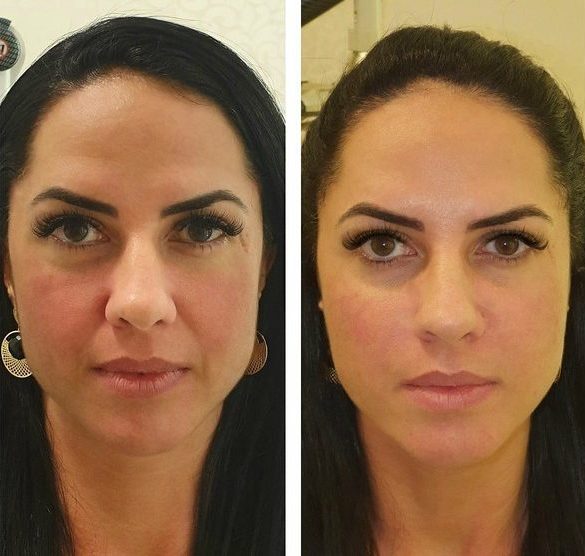 Antes e depois veja os famosos que fizeram harmonização facial ISTOÉ Independente