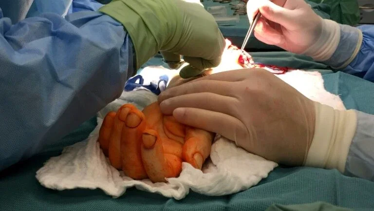 Homem que nasceu sem uma das mãos recebe transplante na Polônia