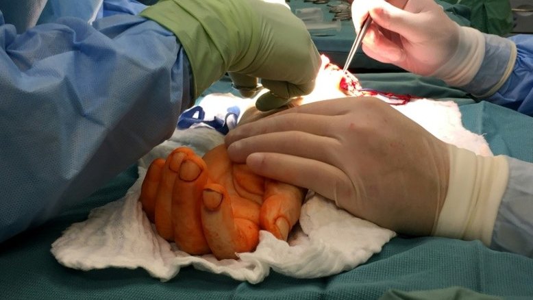 Homem que nasceu sem uma das mãos recebe transplante na Polônia