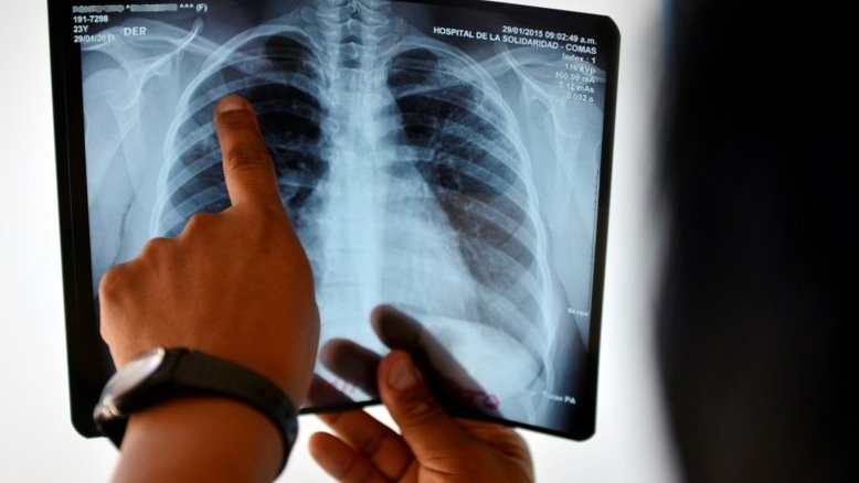 Especialistas alertam para risco de tuberculose multirresistente