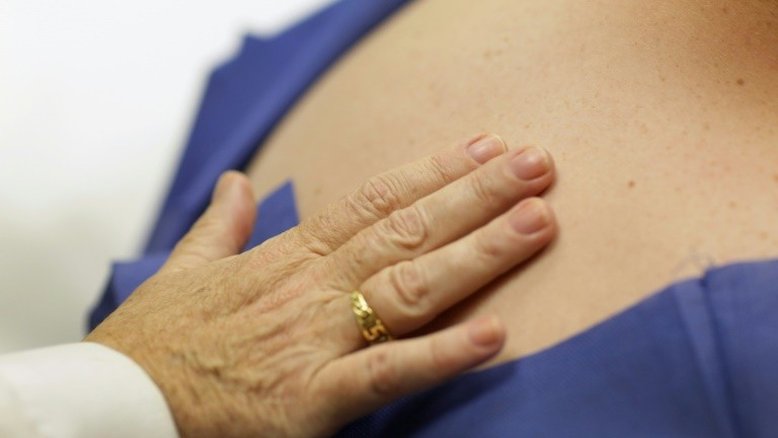 Lesões podem ser sinal de melanoma, o câncer de pele mais grave