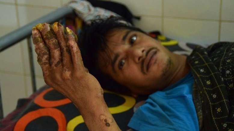 Após 24 cirurgias em um ano, 'Homem Árvore' sofre recaída