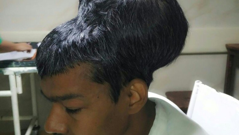 Paciente indiano sobrevive à extração de tumor cerebral de quase 2 kg