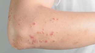 Novo medicamento para tratar dermatite atópica chega ao Brasil