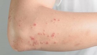 Novo medicamento para tratar dermatite atópica chega ao Brasil