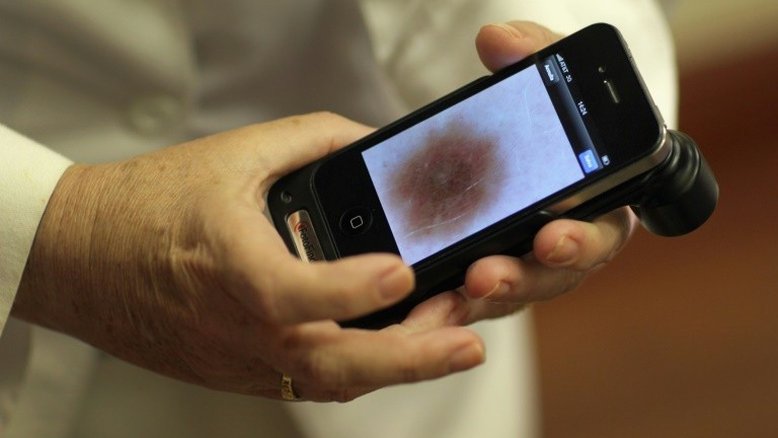 Computador consegue detectar melhor o câncer do que dermatologistas