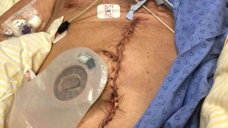 Foto de incisão no abdome de Bolsonaro é verdadeira