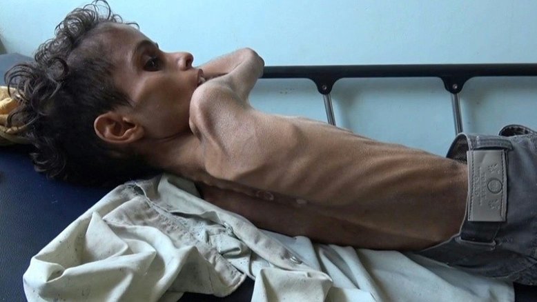 Ghazi Saleh, o rosto da fome no Iêmen
