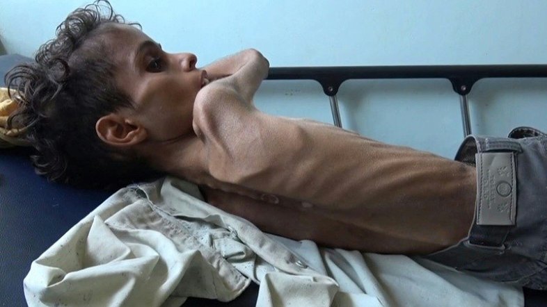 Ghazi Saleh, o rosto da fome no Iêmen