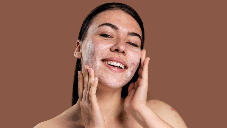 mulher com acne hormonal passando creme no rosto e sorrindo