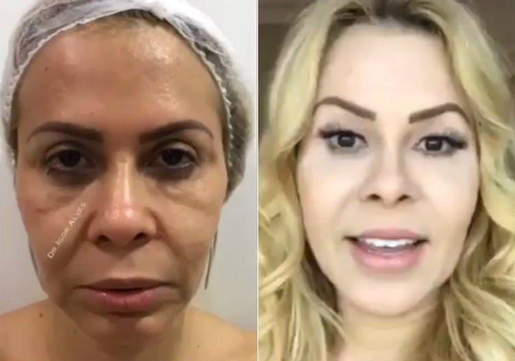 Joelma mostra 'antes e depois' de harmonização facial e surpreende fãs 4 Joelma mostra 'antes e depois' de harmonização facial e surpreende fãs