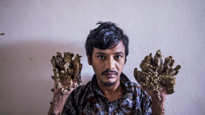 O 'homem-árvore' pede para que suas mãos sejam amputadas