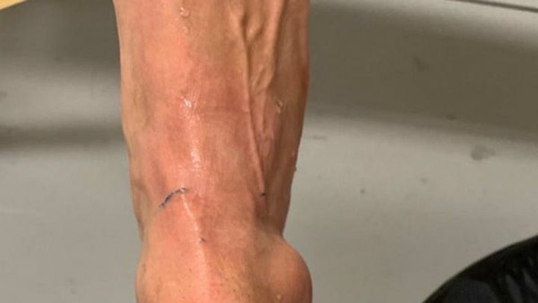 Neymar posta foto de tornozelo machucado, PSG fala em 72h para diagnóstico médico