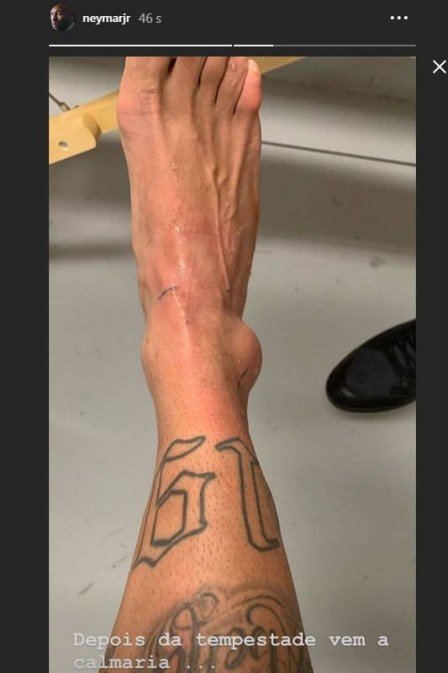 Neymar posta foto de tornozelo machucado, PSG fala em 72h para diagnóstico médico 2 Neymar posta foto de tornozelo machucado, PSG fala em 72h para diagnóstico médico