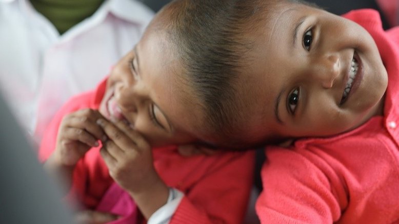 Siamesas unidas pela cabeça são separadas em Bangladesh