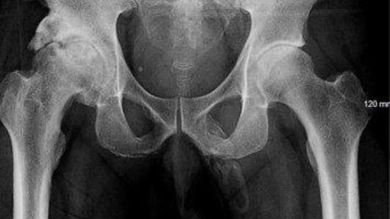 Divulgação/Urology Case Reports