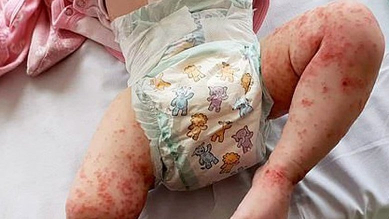 Bebê quase morre após contrair herpes através de beijo de parente