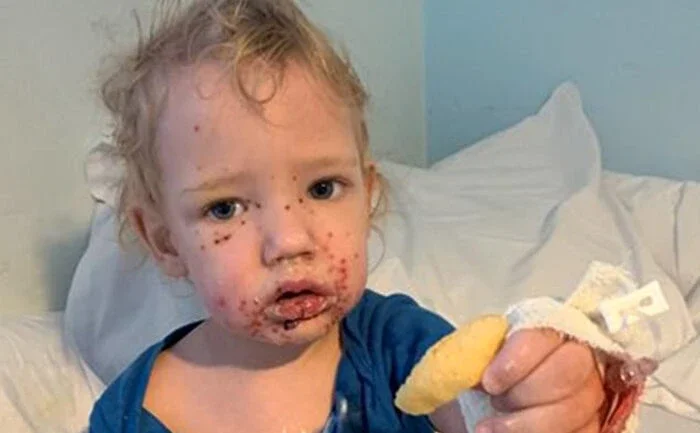 Novo caso de bebê contaminado com herpes alerta para beijo em crianças