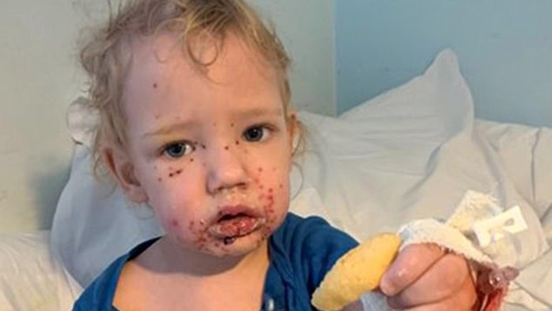 Novo caso de bebê contaminado com herpes alerta para beijo em crianças