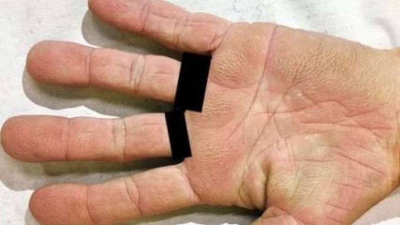 Mulher descobre câncer de pulmão por conta de mãos aveluladadas
