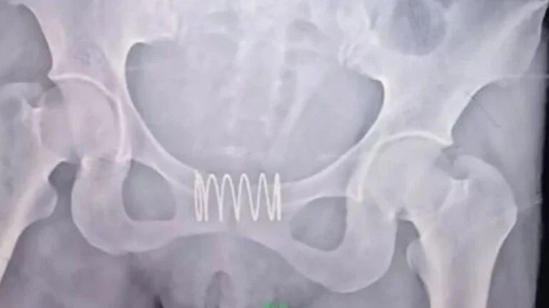 Mulher é operada após colocar mola de metal na vagina para não engravidar