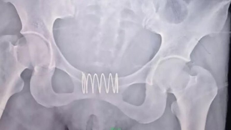 Mulher é operada após colocar mola de metal na vagina para não engravidar