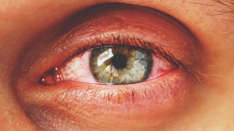 Médicos descobrem abelhas minúsculas morando no olho de uma mulher