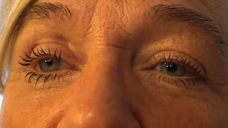 Mulher perde olho após tomar banho usando lentes de contato