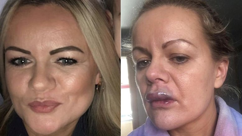 Mulher fica com boca inchada e cheia de pus após preenchimento labial