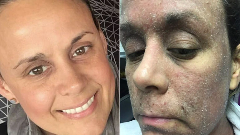 Mulher perde pele do rosto após anos usando mesmo creme