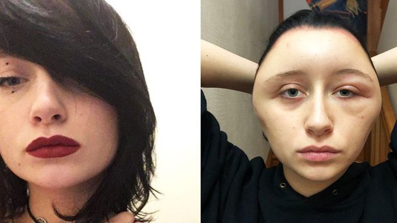 Tintura de cabelo faz jovem ficar com rosto deformado e quase morrer