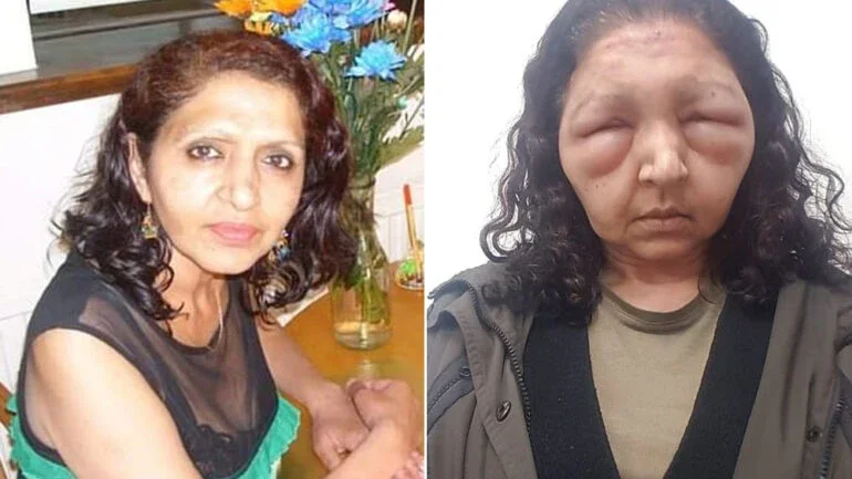Mulher fica com rosto desfigurado após usar tintura natural de cabelo