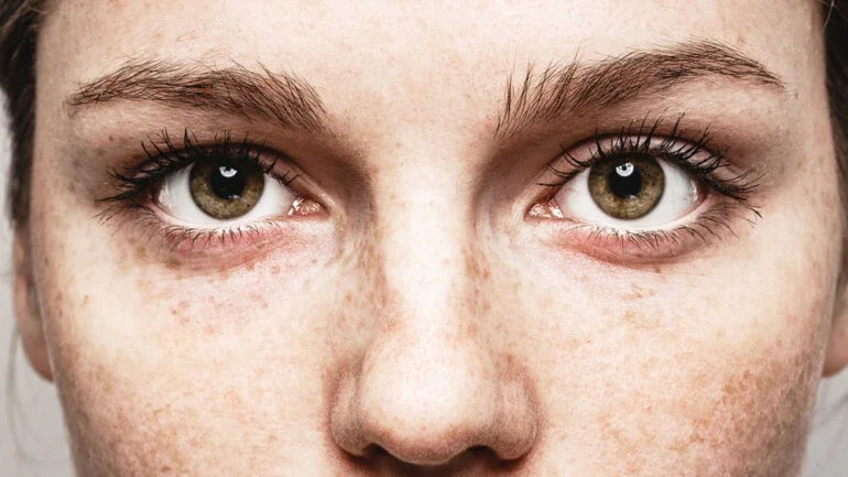 É possível ter vermes nos olhos?