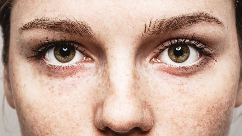 É possível ter vermes nos olhos?