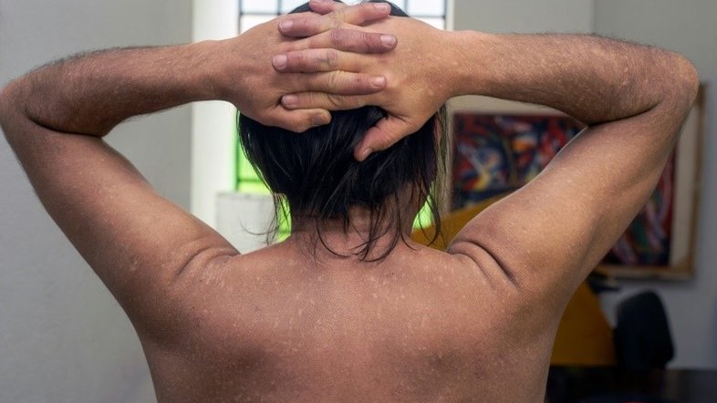 Narcodoenças na Colômbia, a sequela silenciosa no maior produtor de cocaína