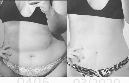 Filha de Silvia Pfeifer mostra novo corpo após eliminar 63kg com cirurgia 5 Filha de Silvia Pfeifer mostra novo corpo após eliminar 63kg com cirurgia