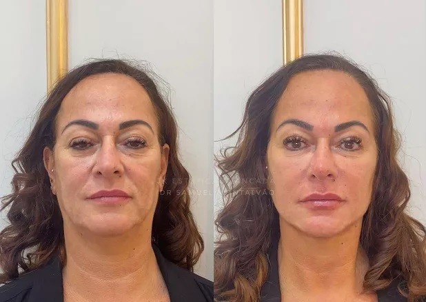 Nadine Gonçalves faz harmonização orofacial e mostra antes e depois; veja foto 4 Nadine Gonçalves faz harmonização orofacial e mostra antes e depois; veja foto