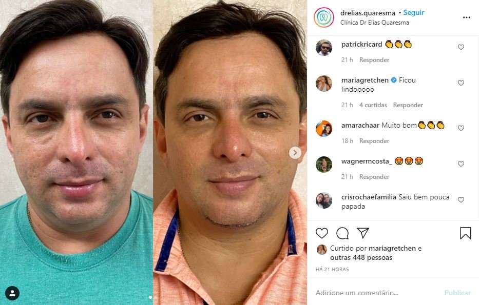 Às vésperas de casamento, noivo de Gretchen faz remoção da papada 4 Às vésperas de casamento, noivo de Gretchen faz remoção da papada
