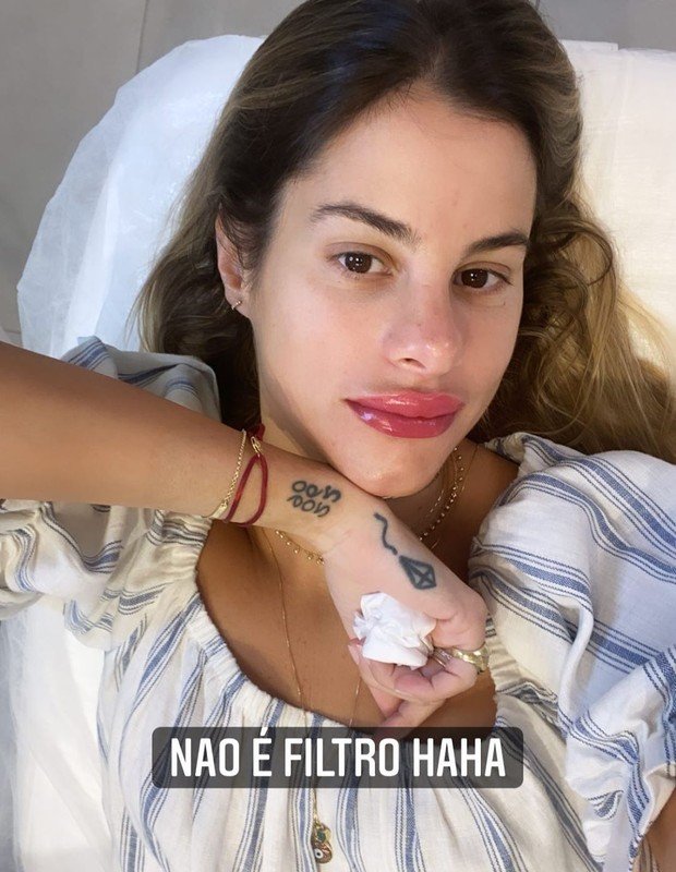 "Não é filtro", diz Shantal ao mostrar boca inchada após procedimento