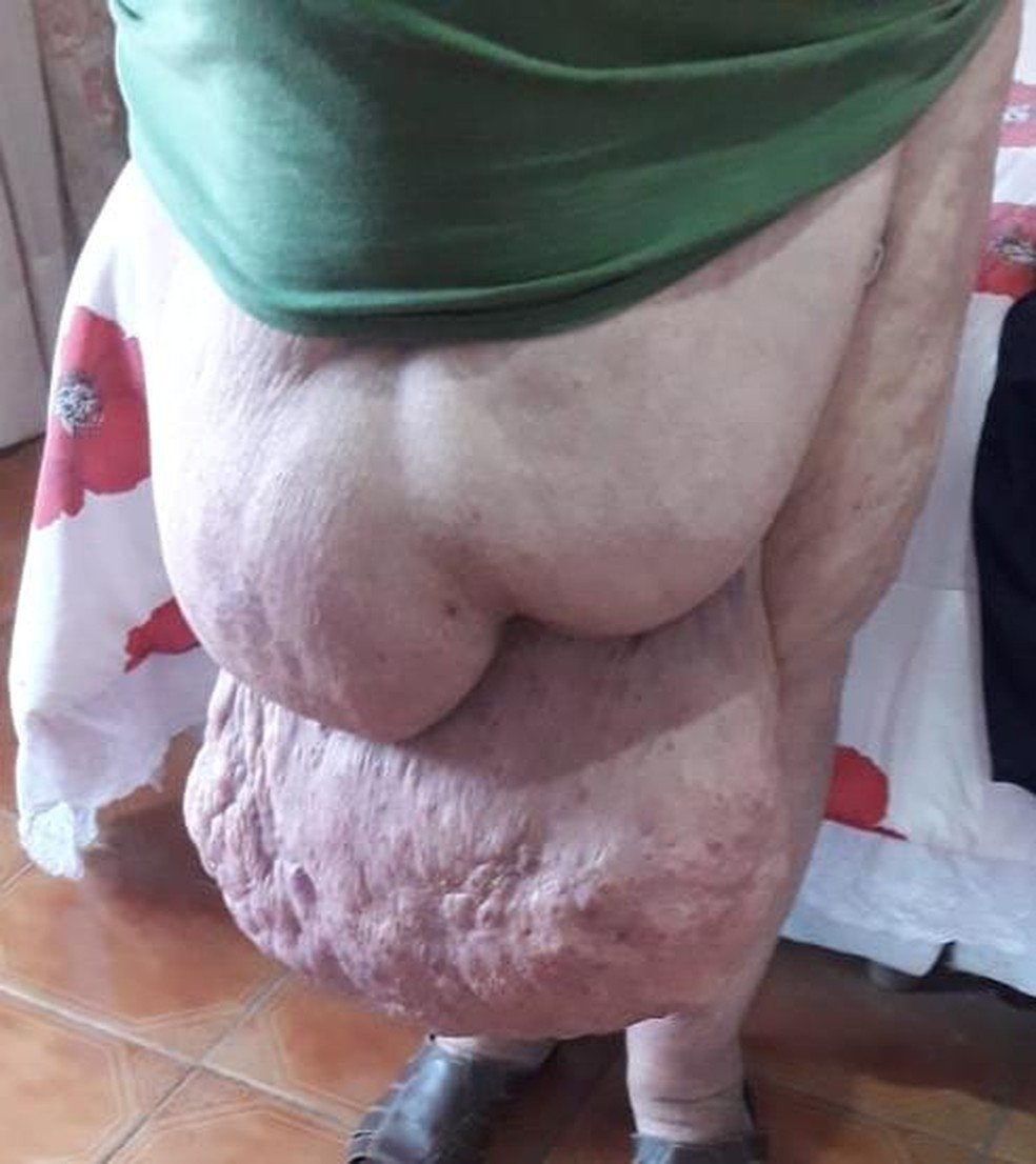 Idoso aguarda cirurgia para remover hérnia gigante com mais de 30 kg 4 Idoso aguarda cirurgia para remover hérnia gigante com mais de 30 kg
