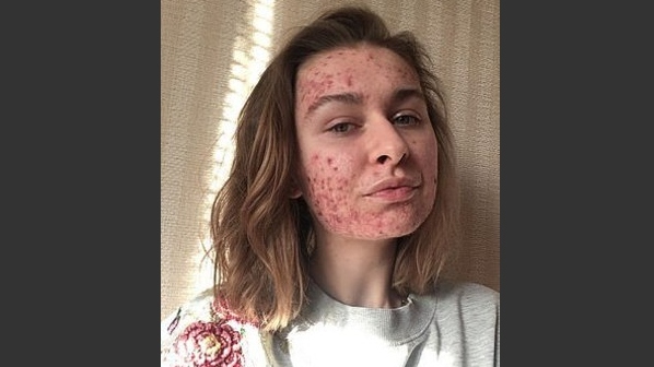Ucraniana relata como dieta praticamente eliminou seu problema com acne