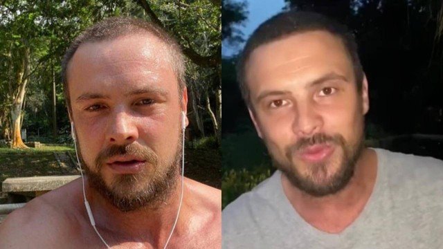 Antes e depois de transplante capilar de Sérgio Guizé