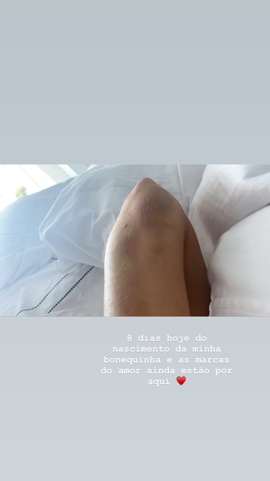 Romana Novais mostra "marcas de amor" deixadas por parto da filha