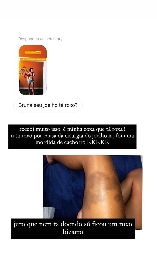 Bruna Griphao mostra hematomas na perna após levar mordida de cachorro 4 Bruna Griphao mostra hematomas na perna após levar mordida de cachorro