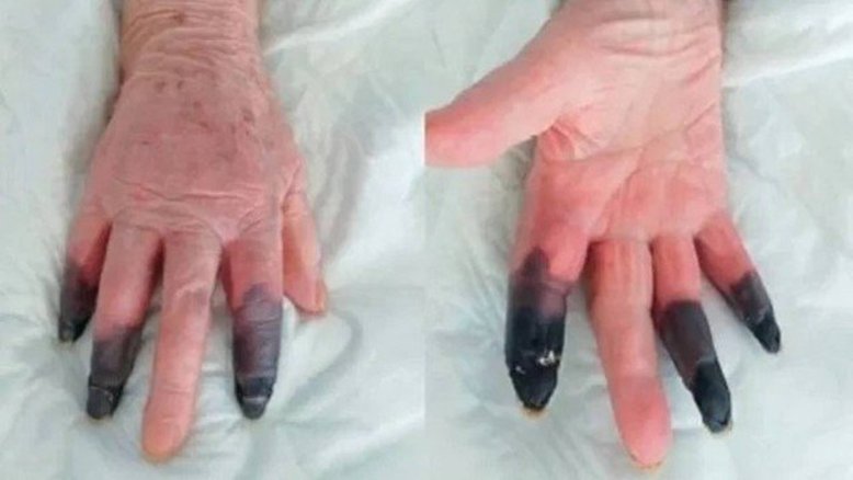 Divulgação/ European Journal of Vascular and Endovascular Surgery