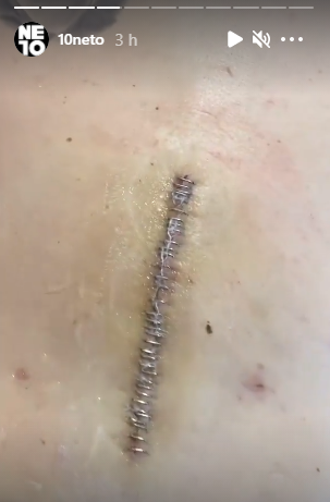 Em recuperação, Neto mostra limpeza de corte após cirurgia na coluna
