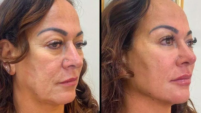 Mãe de Neymar realiza harmonização facial