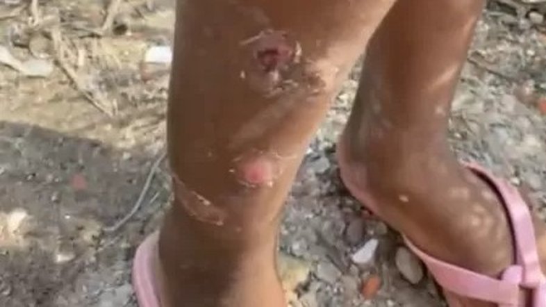 'Sarna humana' se alastra e chega a bairro rico no litoral paulista