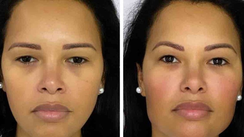 Ariadna mostra resultado de harmonização facial